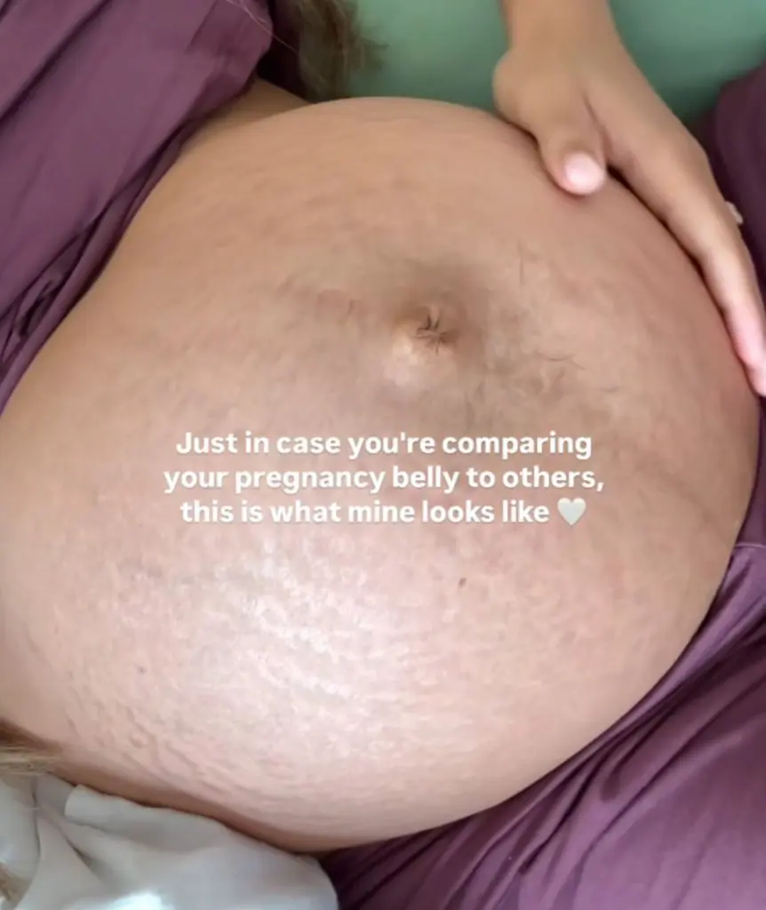 Celebrating the first Stretch Mark